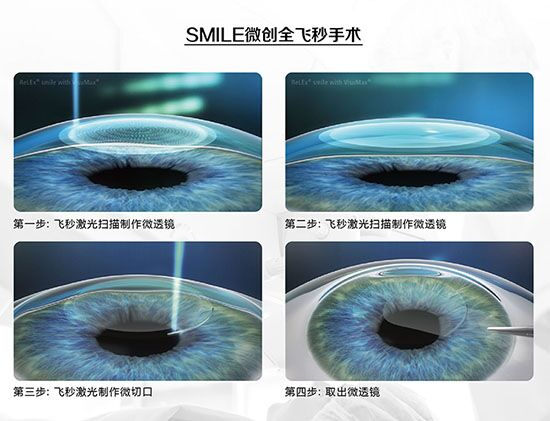 蔡司全飛秒、蔡司半飛秒近視手術(shù)與蔡司全飛秒flex手術(shù)