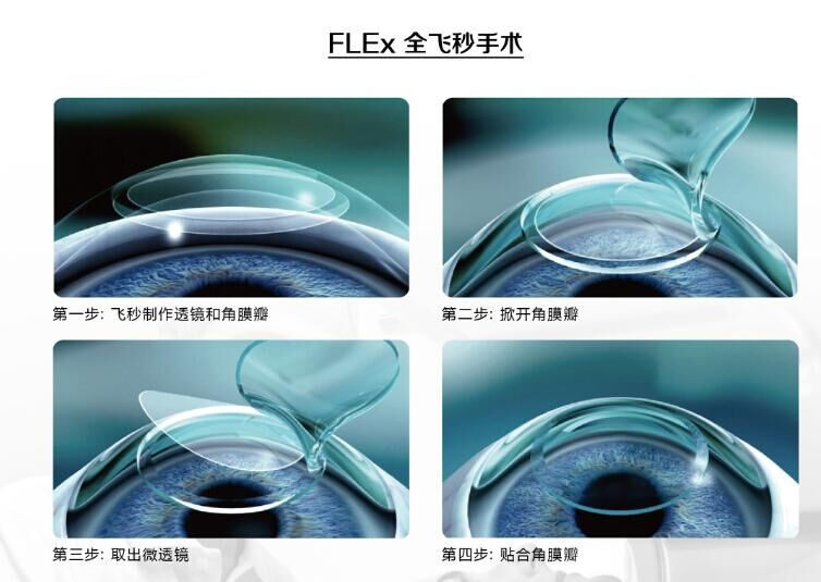 蔡司全飛秒、蔡司半飛秒近視手術(shù)與蔡司全飛秒flex手術(shù)