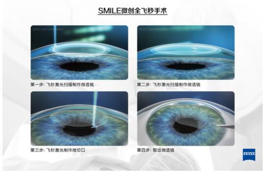 有近視，全飛秒激光手術(shù)后視力更好