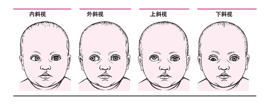 蘭州普瑞眼視光醫(yī)院專家：家長(zhǎng)很粗心孩子有斜弱視都不知道