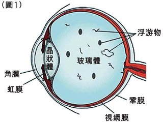 高度近視怎么辦?視網(wǎng)膜脫落能嗎?